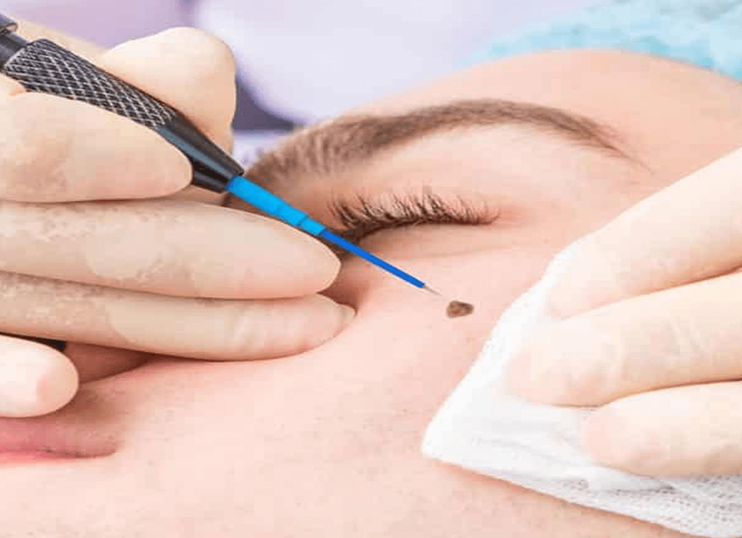 Wart And Skin Tag Removal